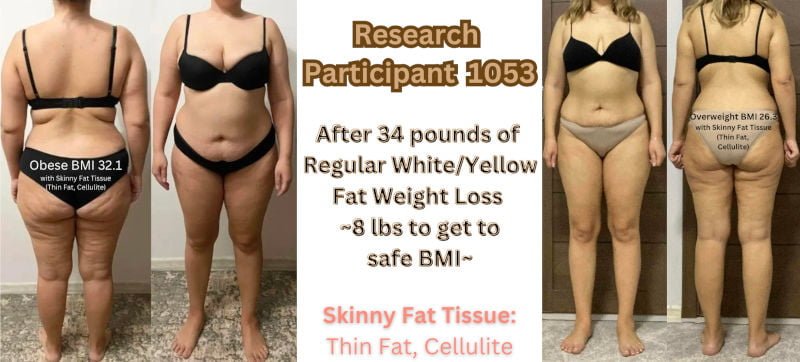 Research Participant 1053 - Skinny Fat Tissue, Thin Fat & Cellulite