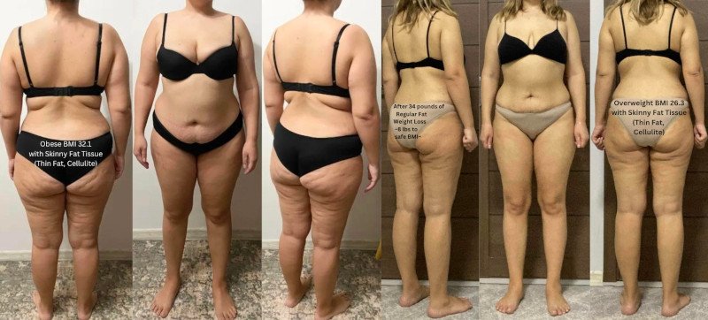 RP 1053 Before and After Regular Fat Weight Loss - How Long to Get Rid of Skinny Fat (Cellulite, Thin Fat)?