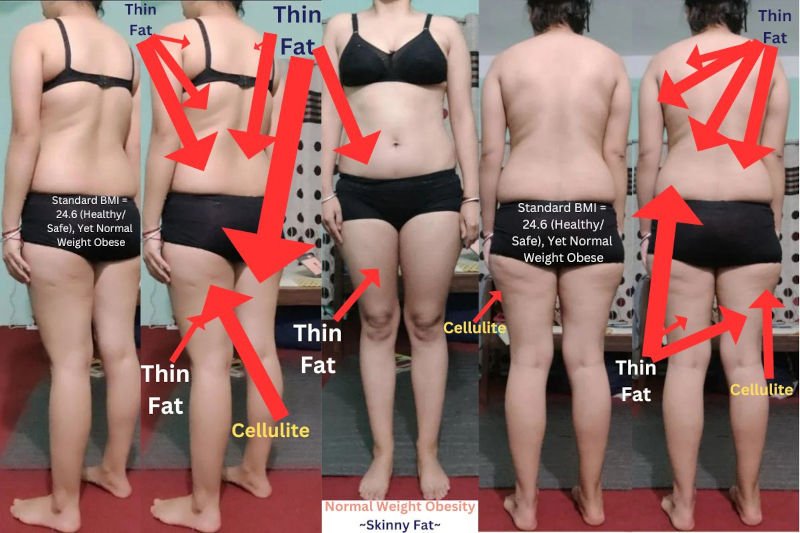 Normal Weight Obesity - Skinny Fat Female Low BMI