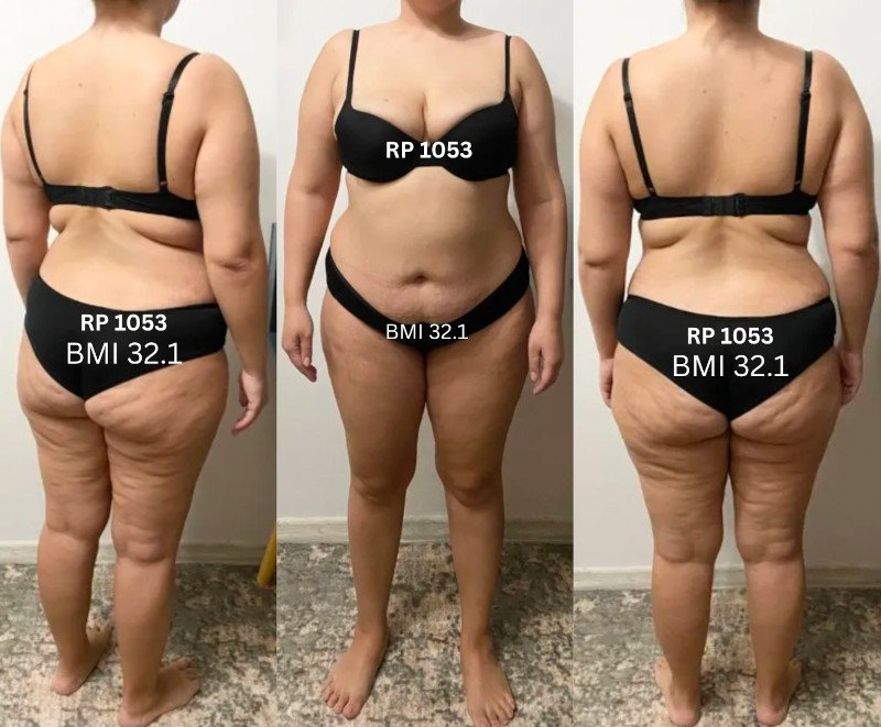 Research Participant 1053 - Before Weight Loss, Obese BMI 32.1 with Thin Fat $ Cellulite Skinny Fat
