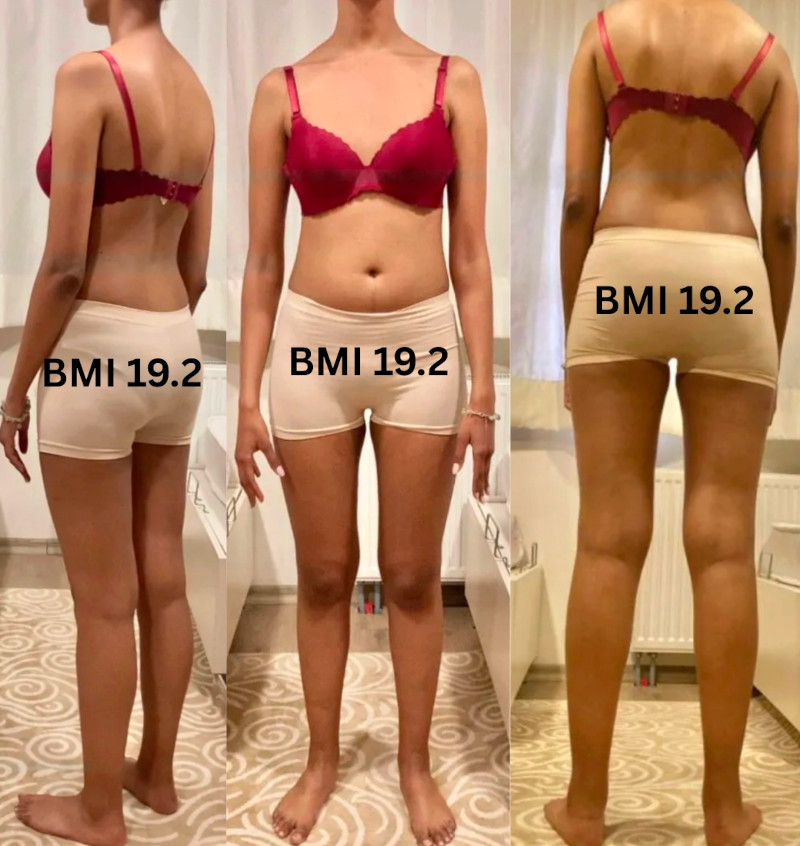 Why Do I Have A Skinny Body But Fat Stomach – Skinny Fat Question